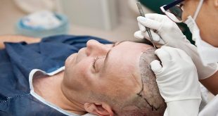 Pioneering the Future: AI's Promising Role in Improving Hair Transplant Procedures
